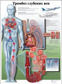 ZVR6368L Тромбоз глубоких вен