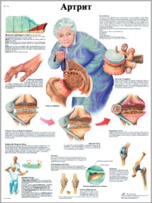 ZVR6123L Артрит, плакат, размер 50х67 см