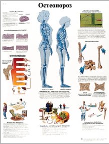 ZVR6121L Остеопороз